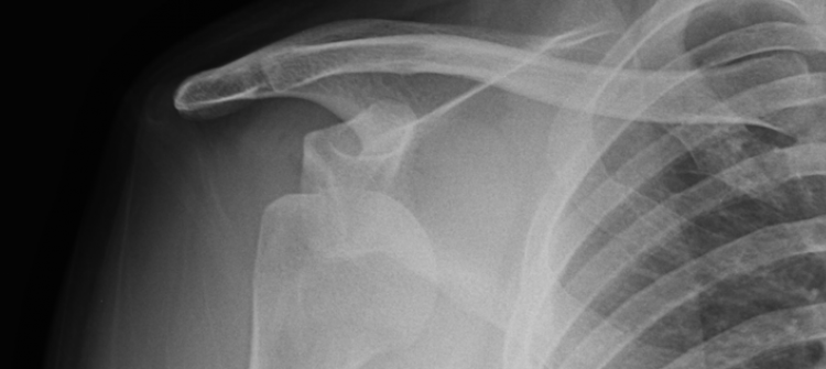 Does Surgery have any added value in the management of Atraumatic Shoulder Instability?